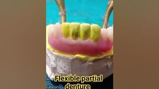 flexible partial denture by Ali dental ceramic and ideas #partialdenture #removabledenture #teeth