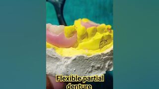 Flexible partial denture by Ali dental ceramic and ideas #removabledenture #completedenture