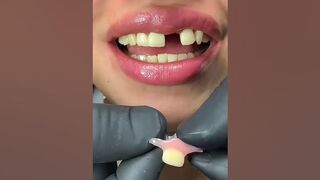 Solution With Flexible Dental Prosthesis of 1 Tooth #dentist #prosthesisdental #shortvideo